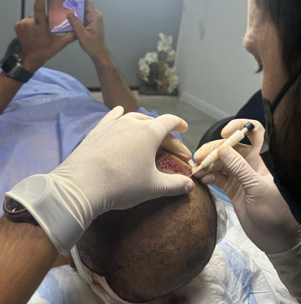 DHI HAIR TRANSPLANT (DIRECT HAIR IMPLANTATION)