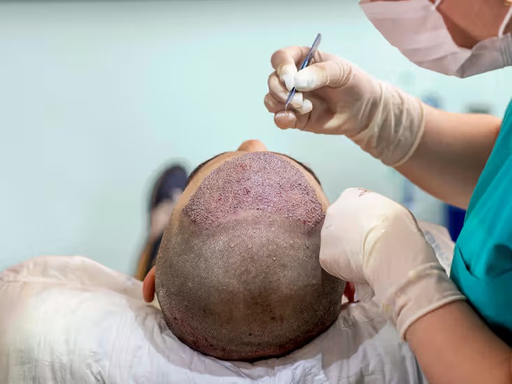 Fue HAIR TRANSPLANT (FOLLICULAR UNIT EXRACTION)